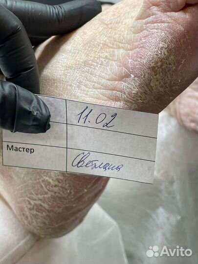 Педикюр, подологический педикюр