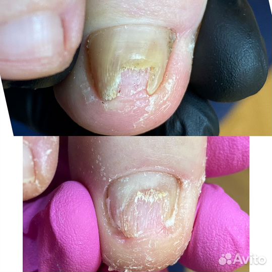 Подологический педикюр