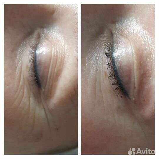 СМАС лифтинг