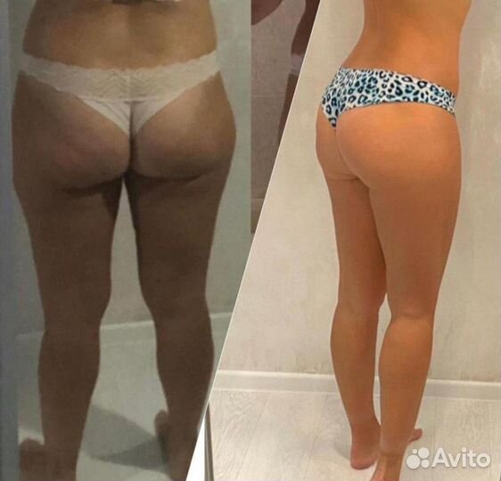 LPG массаж Аппаратный массаж