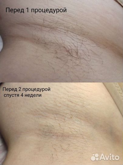 Электроэпиляция