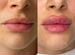 Обучение косметологии / контурной пластике губ