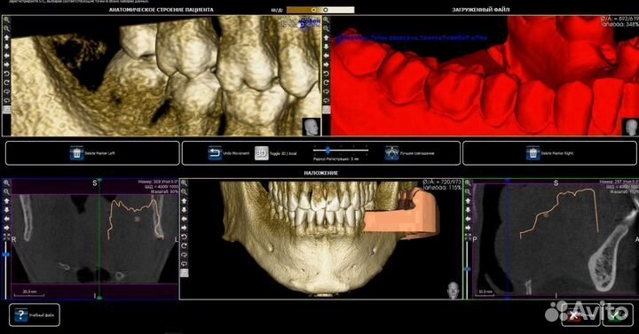 Hyperdent/3shape/ExoCad/3Diagnosys PlastyCad