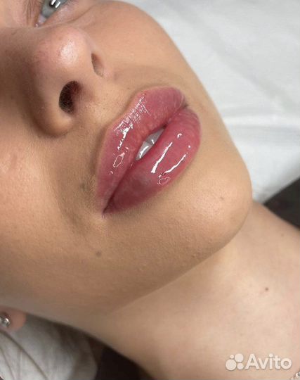 Увеличение губ модель