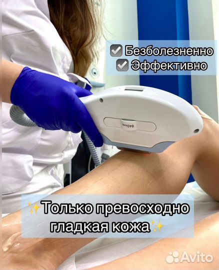 Лазерная эпиляция