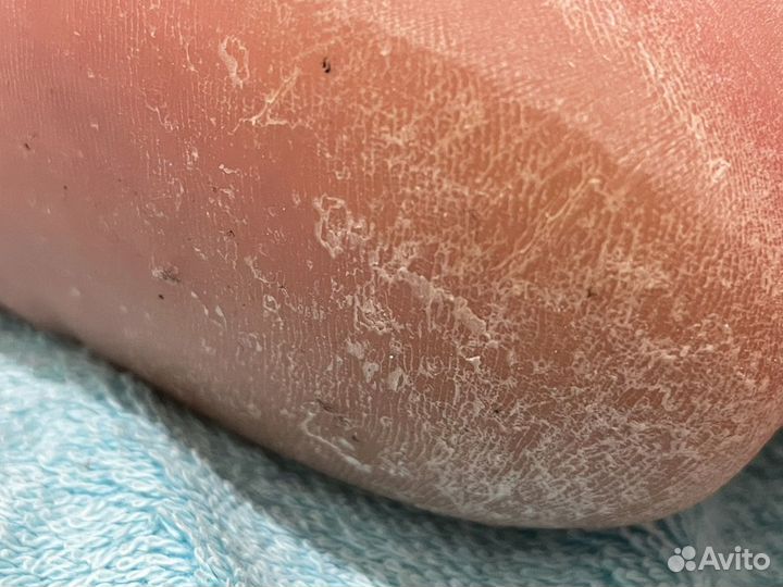 Аппаратный педикюр