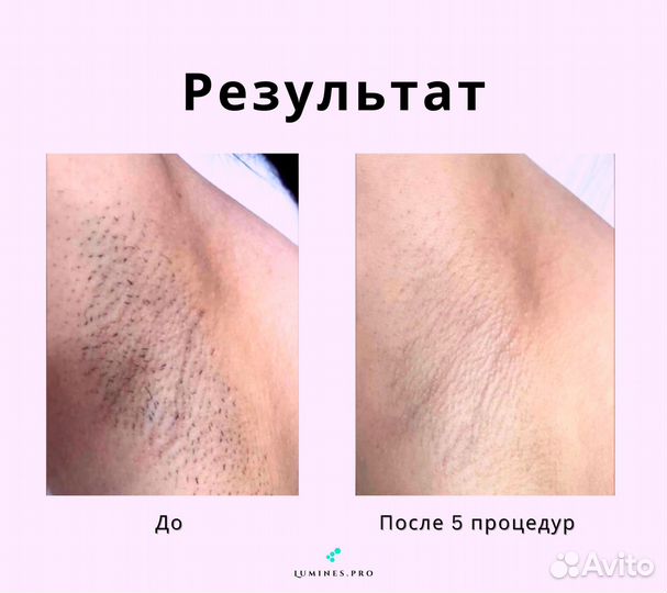 Аппарат для эпиляции Лю-Минес Макс Ван 1200вт