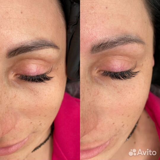 Лазерное удаление тату татуажа