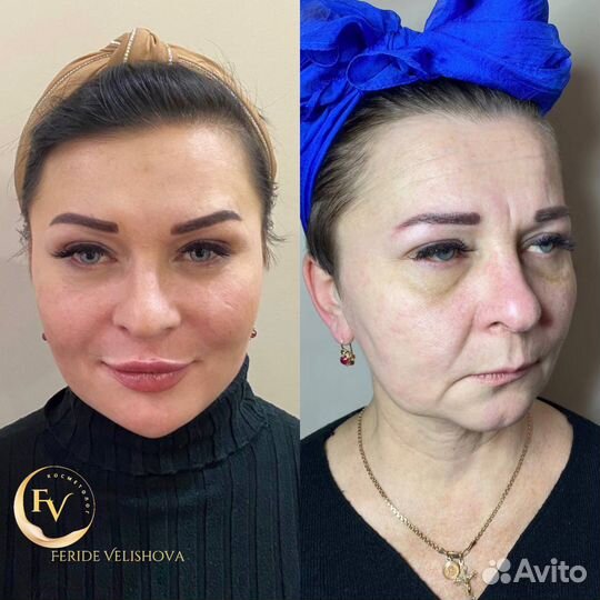 Аугментация губ,Липолитики,Ботокс