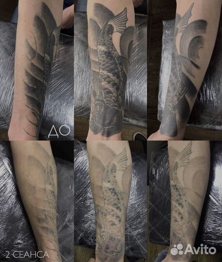 Лазерное удаление тату и татуажа