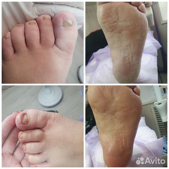 Педикюр всех видов