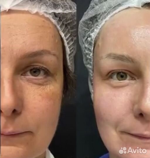 СМАС лифтинг (без боли)