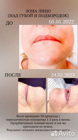 Электроэпиляция
