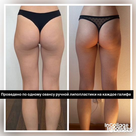 Антицеллюлитный массаж / коррекция фигуры