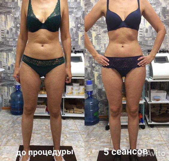 Коррекция фигуры. Липосакция карамельная. Лифтинг