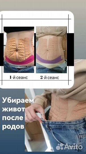 Коррекция фигуры, похудение, тейпирование