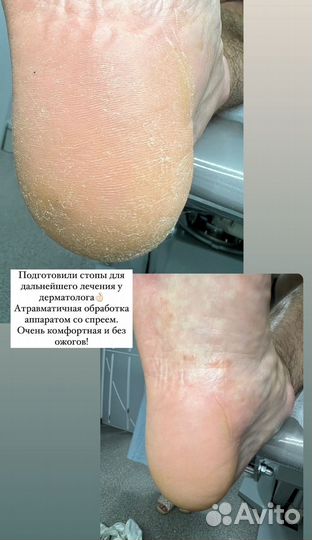 Педикюр подолог