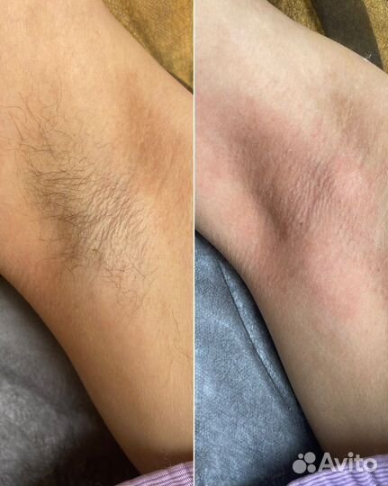 Восковая депиляция