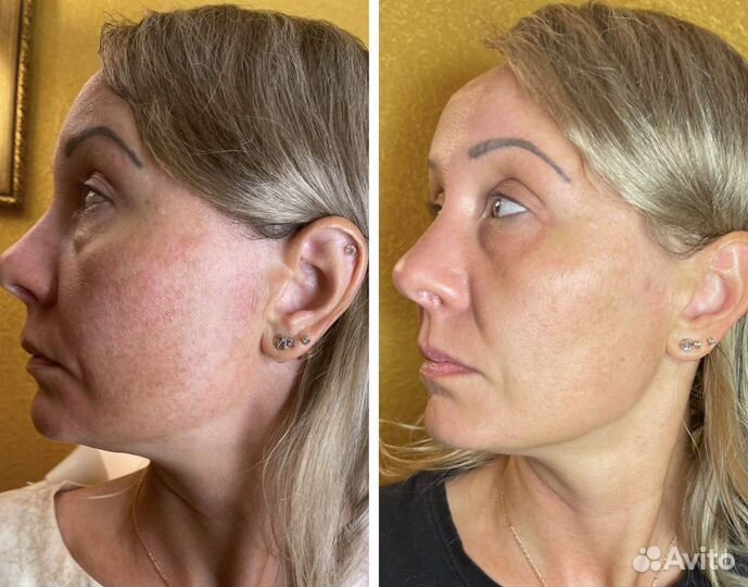 Омоложение холодной плазмой