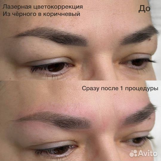 Удаление татуажа бровей, тату