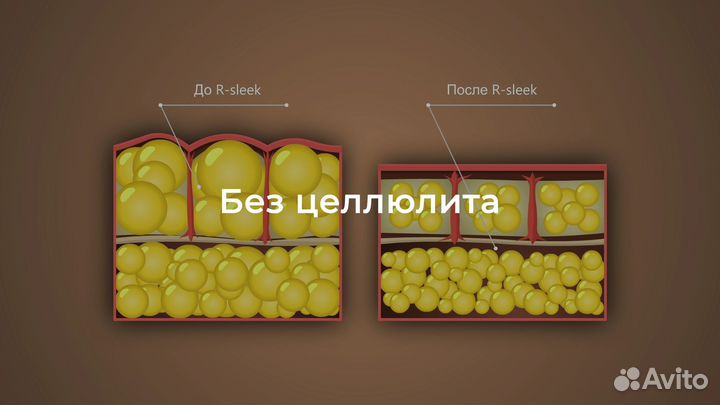 Аппаратный массаж,коррекция фигуры