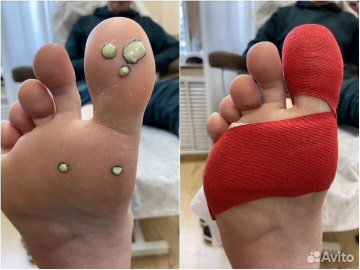 Удаление бородавок на стопах, подолог