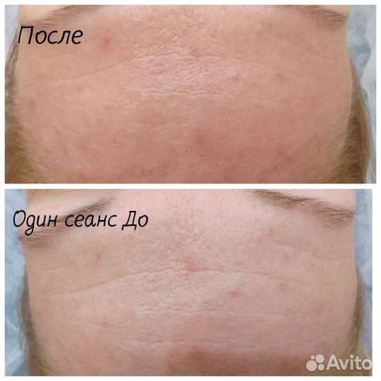 Классический массаж лица