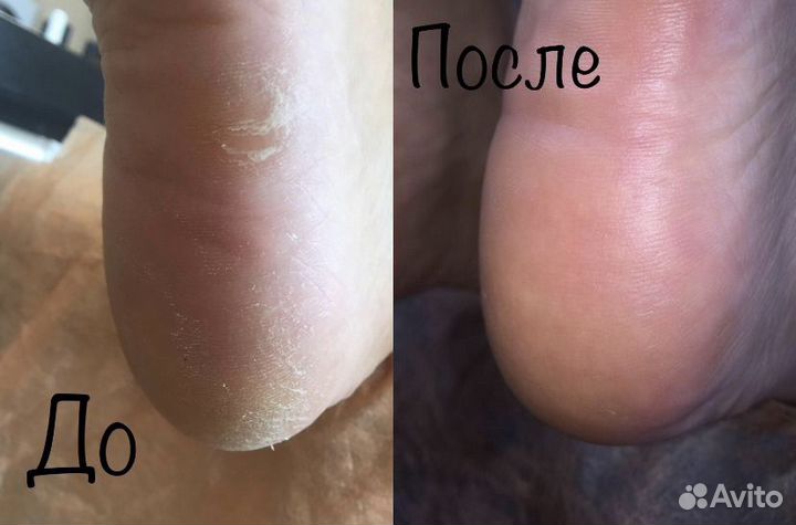Педикюр на дому