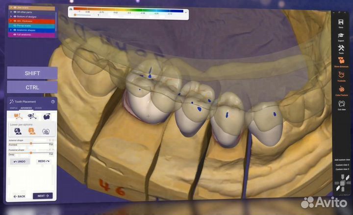Hyperdent/3shape/ExoCad/3Diagnosys PlastyCad