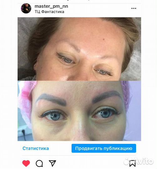 Удаление татуажа