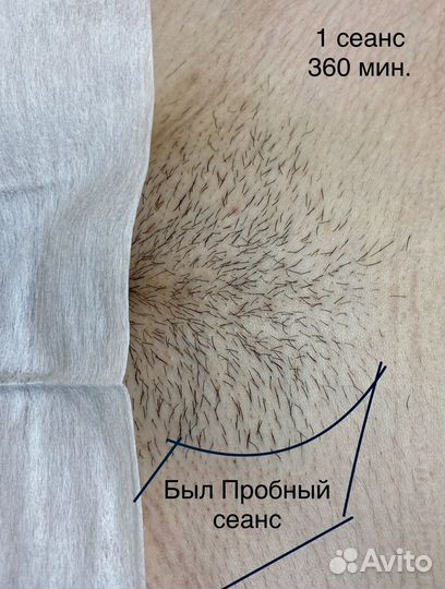 Электроэпиляция