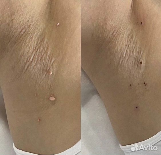 Удаление папиллом