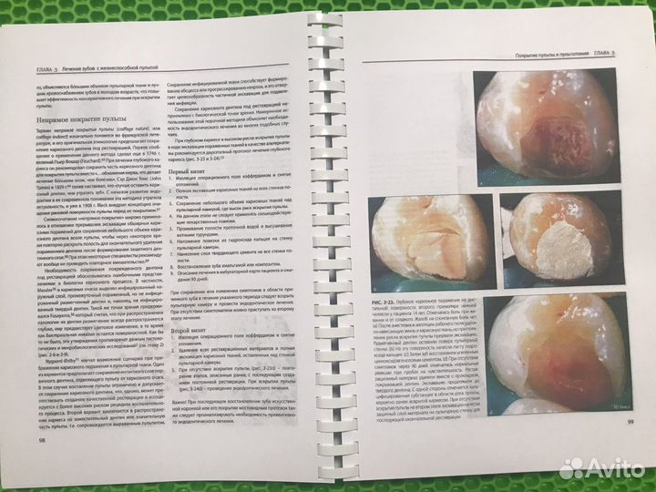 Эндодонтия Рикуччи