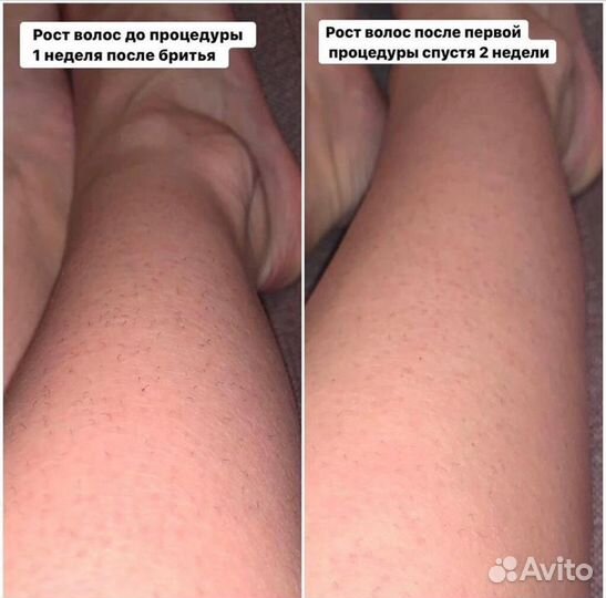 Лазерная эпиляция: глубокое бикини