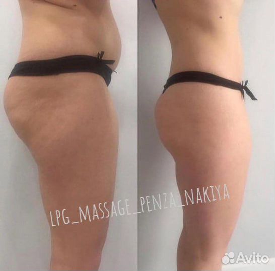 Аппаратный LPG массаж лица и тела-вакуумный антице