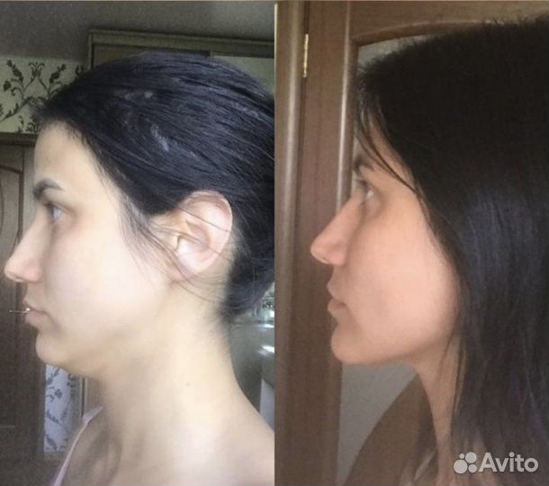 Омоложение лица