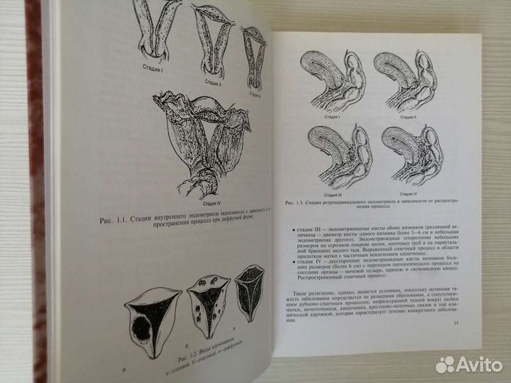 Эндометриозы (2006г.) / Л. Адамян