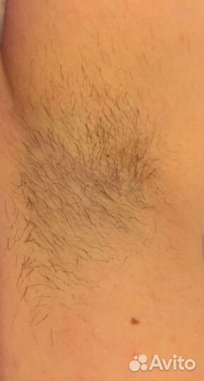 Эпиляция (шугаринг)