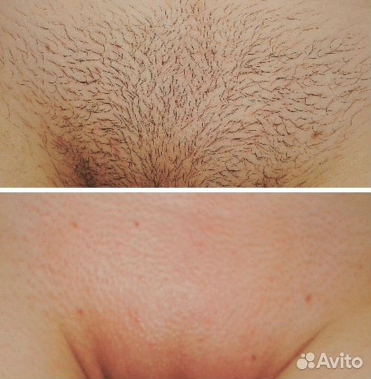 Депиляция воск шугаринг