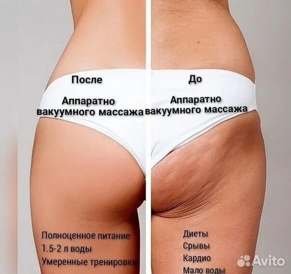 Аппаратный вакуумный массаж