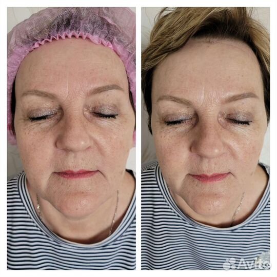 Массаж лица и тела. Lpg массаж. Коррекция фигуры