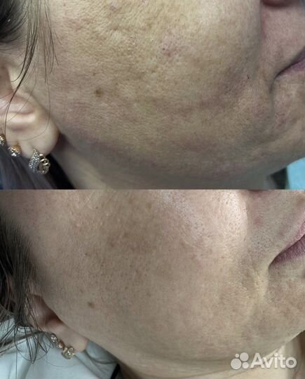 Плазменное омоложение мтуси 