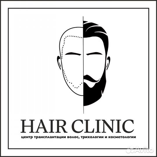 Пересадка волос в Казани