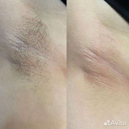 Шугаринг (Мастер Сахарной Депиляции)