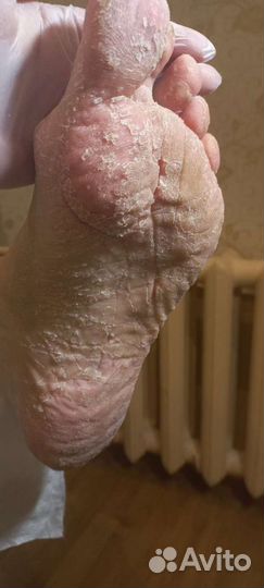 Аэропедикюр(педикюр смарт диском)