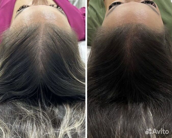 Лечение выпадения волос