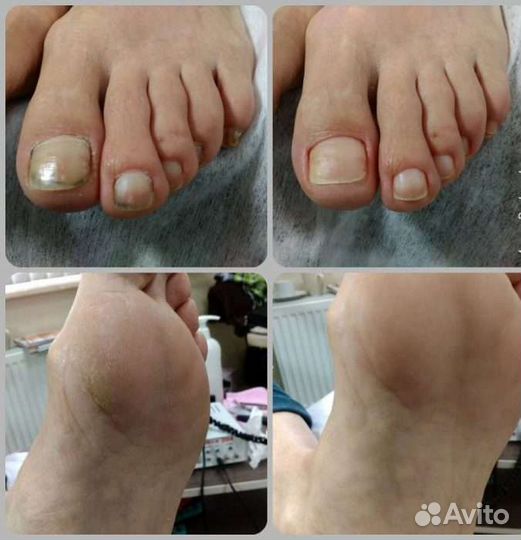 Гигиенический педикюр с выездом на дом