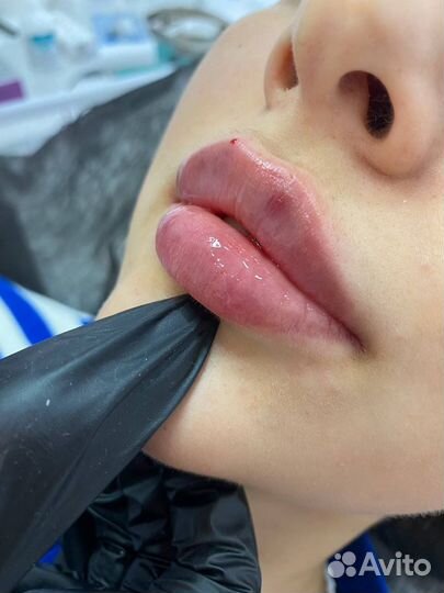 Модель на увеличение губ и биоревитализация