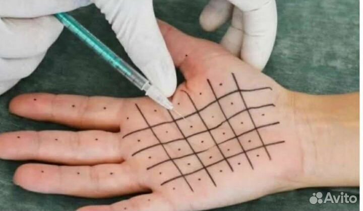 Устранение потливости. Гипергидроз