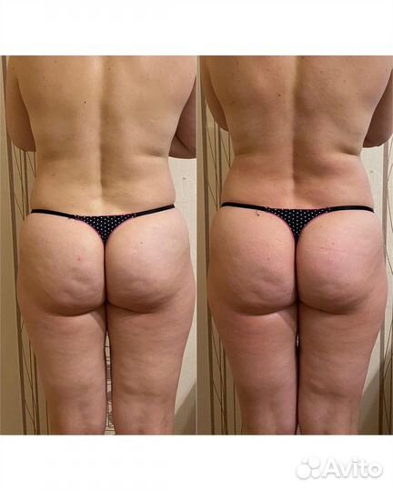 Антицеллюлитный массаж